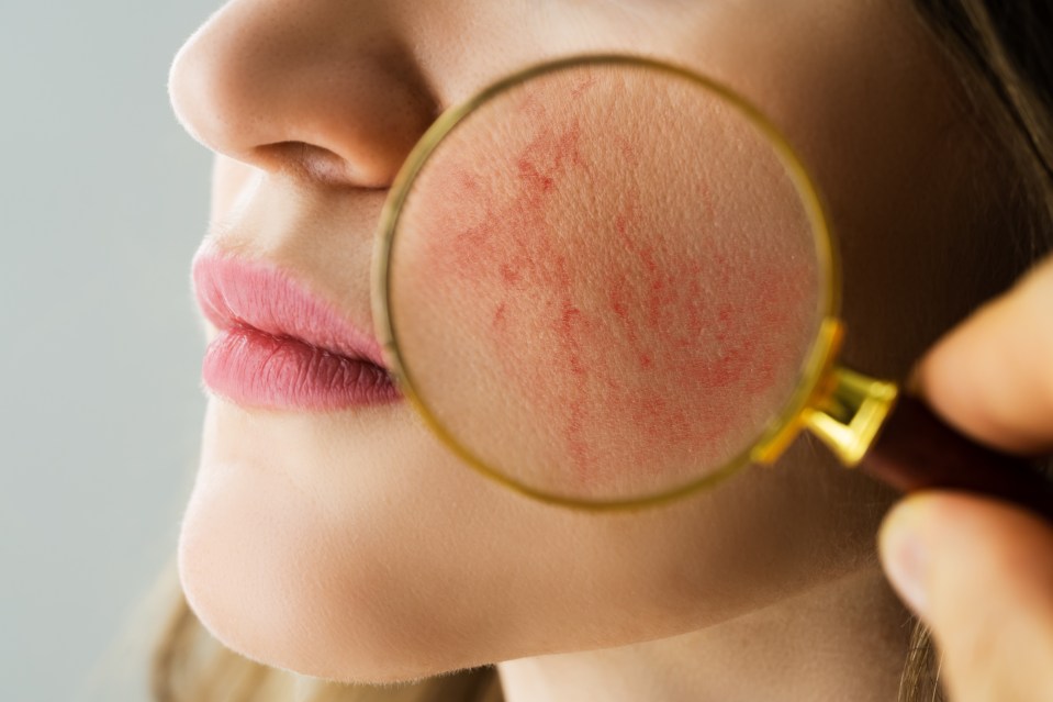 Rosacea causes red patches on your cheeks, nose, forehead and chin