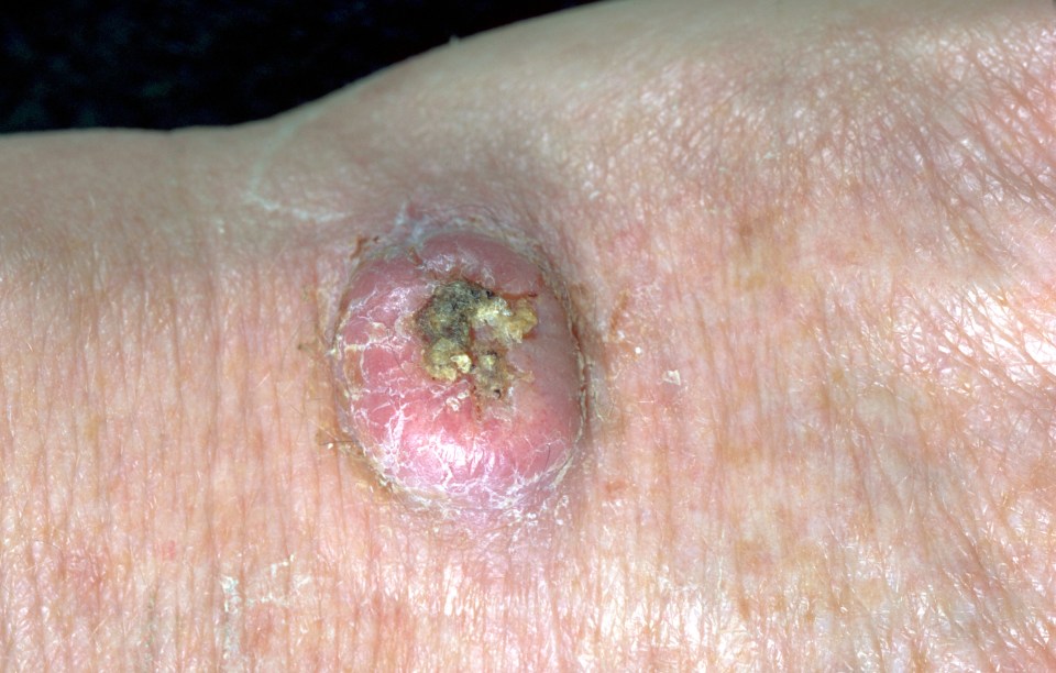 Skin cancers can sometimes look like a spot but it is vital you get checked by your GP if you suspect the disease