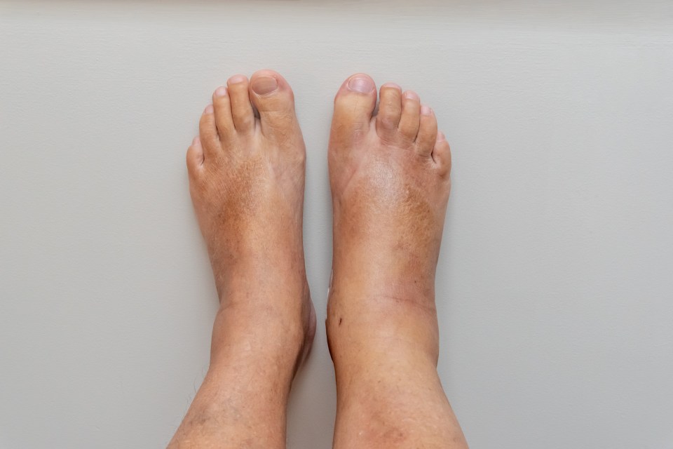 Swelling in your feet - also known as oedema - can be a sign of heart failure