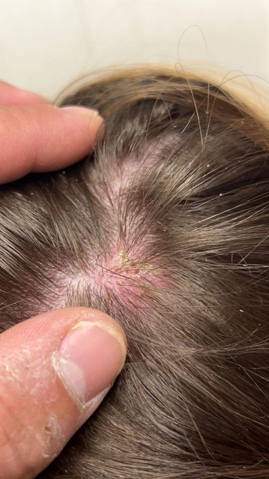 The rash quickly spread to her scalp