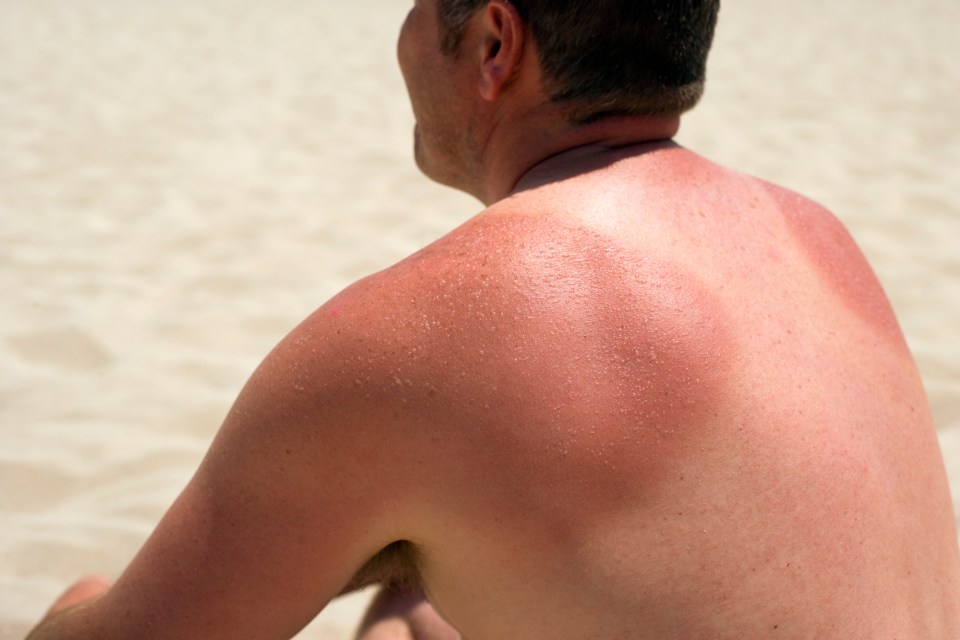 People should take care not to get sunburnt, says Cancer Research UK