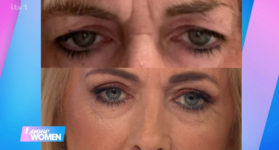 Jane showed off the results of a cosmetic procedure on her eye lids