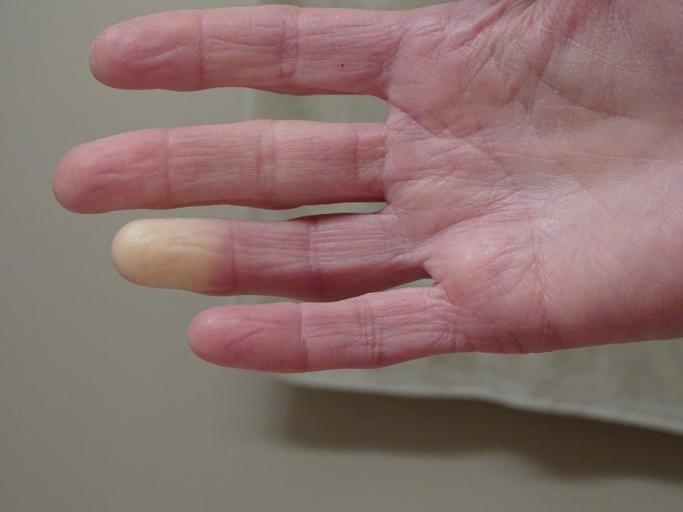 White or blue fingertips could be Raynauds Syndrome