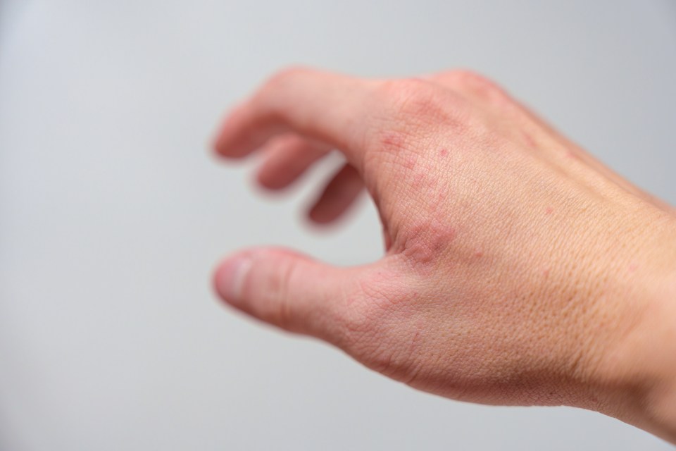 A red itchy rash could be a food allergy