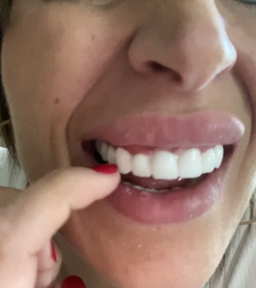 While a dentist helped her fix them and gave her a discount on the £80k treatment