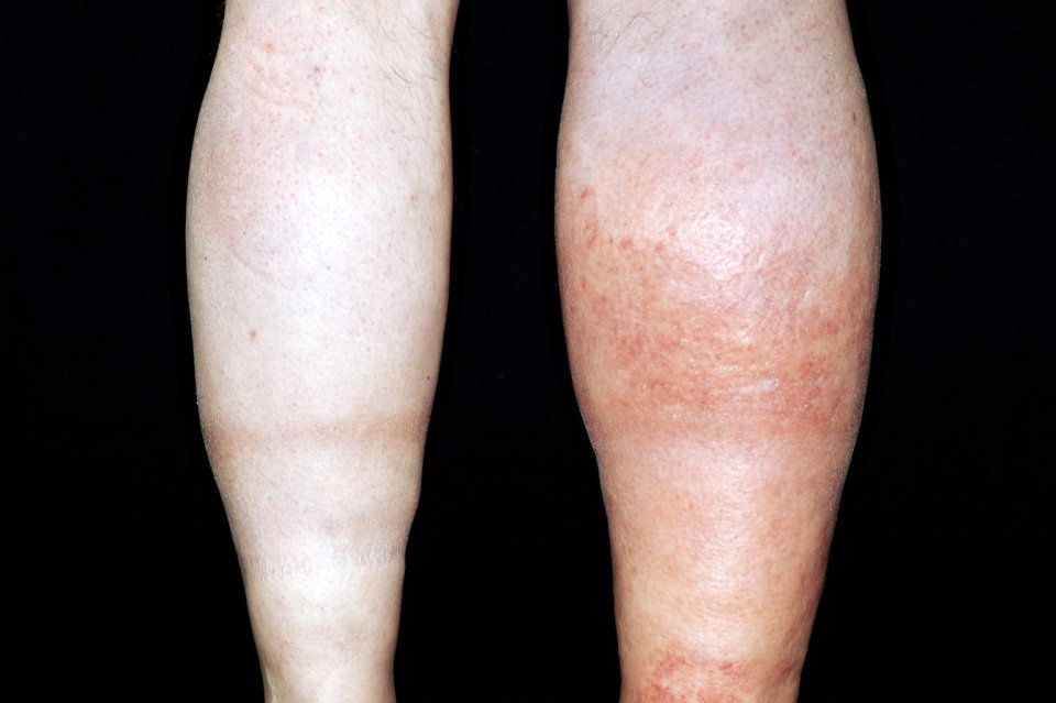 A clot in an arm or leg can cause redness, swelling and pain