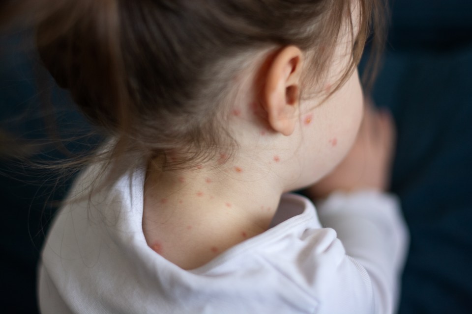 Doctors have urged parents to vaccinate their kids against measles