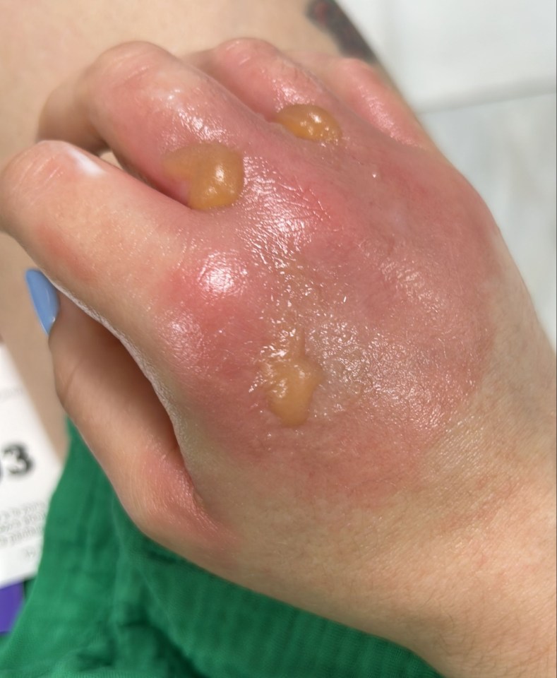 The sap in giant hogweed causes photosensitivity when it touches your skin, resulting in nasty burns, lesions and blisters