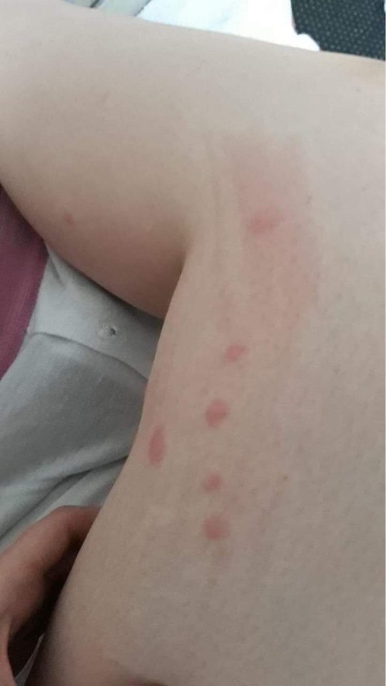 Hettie said: ‘I saw my GP two days after my sunbed session – I was shocked when he diagnosed the contagious skin condition scabies’