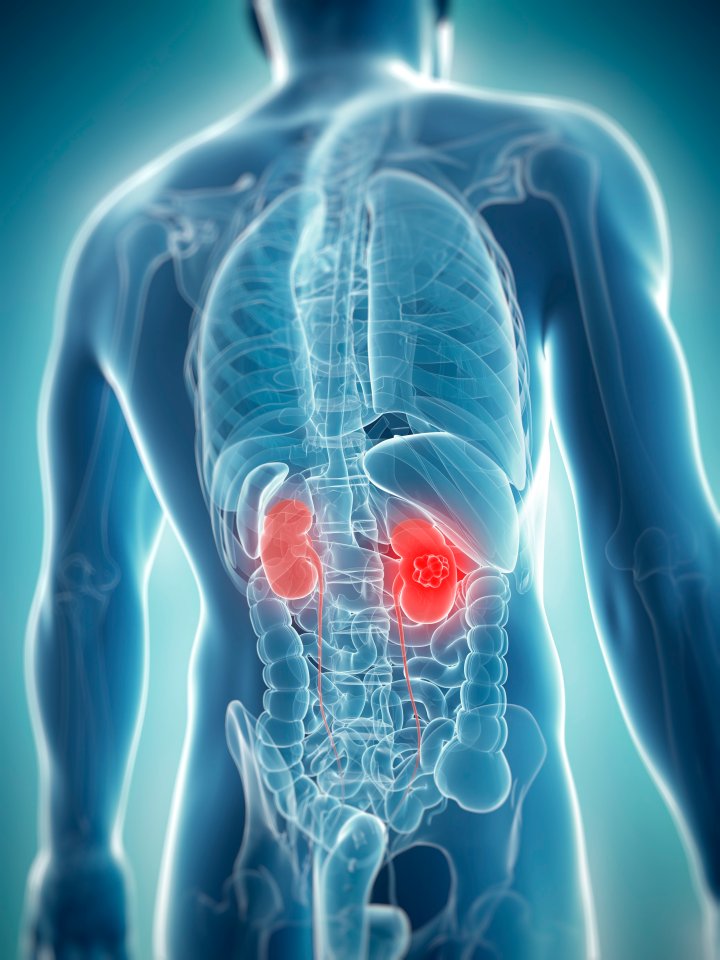 Kidney cancer kills about 4,700 people every year in the UK