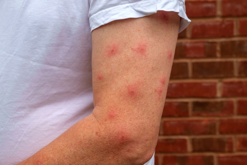 Midges and gnats will leave lots of little red bites