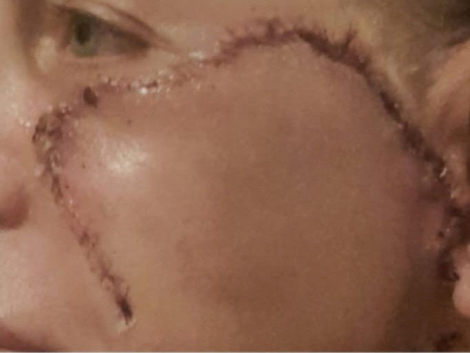 Scars on Kay’s face following her cheek surgery to remove the cancer