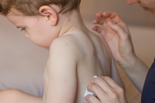 The UK faces a 'very real risk' of a new measles outbreak, experts have warned