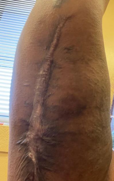 Nasra's has been left "permanently disfigured" (pictured: scarred arm)