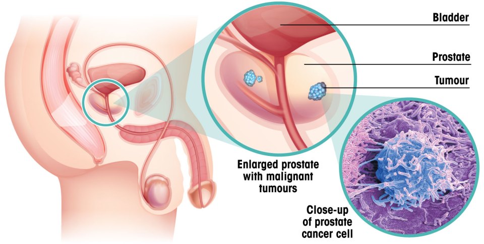 What prostate cancer looks like