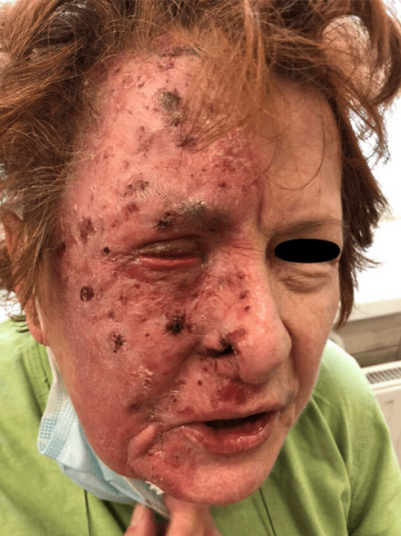 A 70-year-old was left with painful lesions across her face because of a condition that leaves sufferers ripping at their own skin