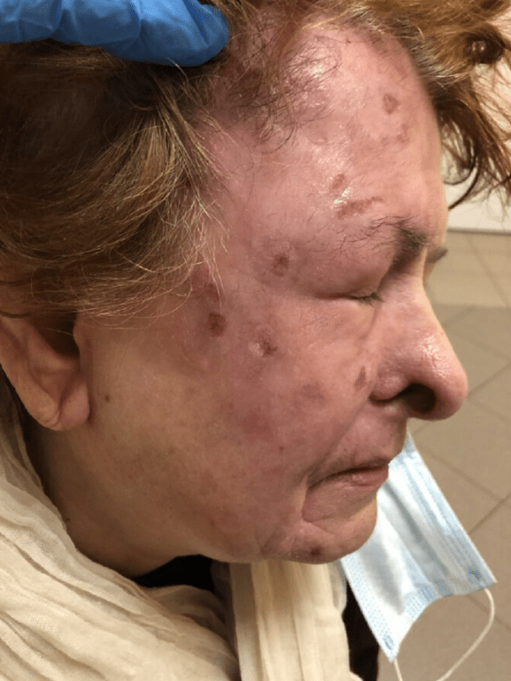 Doctors treated her with anaesthetic ointments and gradually the lesions started to disappear on her face after a month