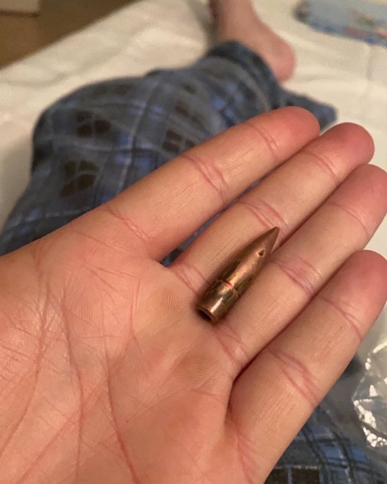 The bullet lodged in his flesh without breaking bones or tearing muscle