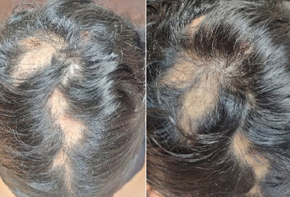 A case of trichotillomania in a woman with ADHD