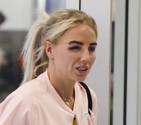 Alex Greenwood still had her bruise from the match on her eye