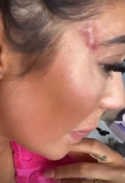 The Geordie Shore star had to go to hospital after the procedure went wrong