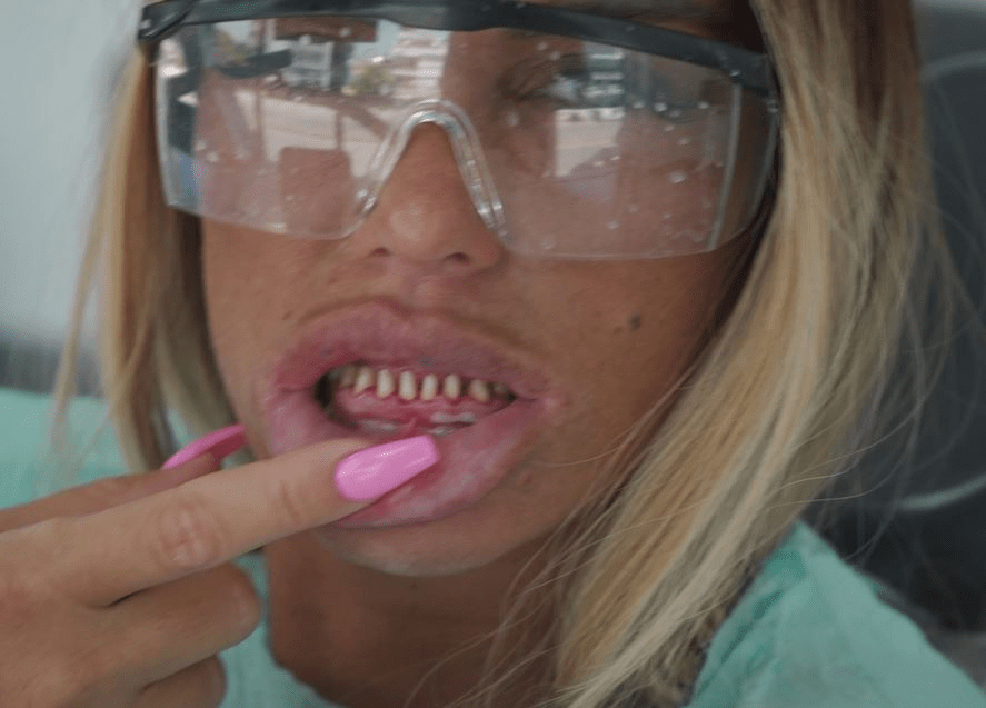 Katie shocked fans before when she revealed her real teeth