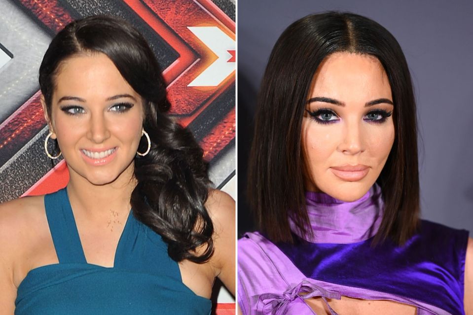 Tulisa before and after Botox