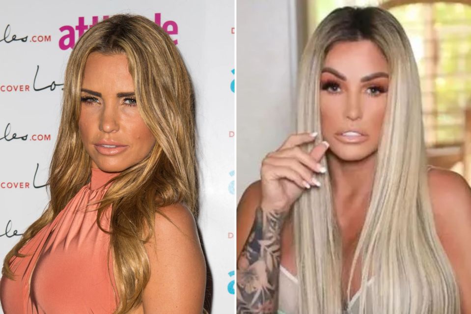 Katie Price before and after Botox