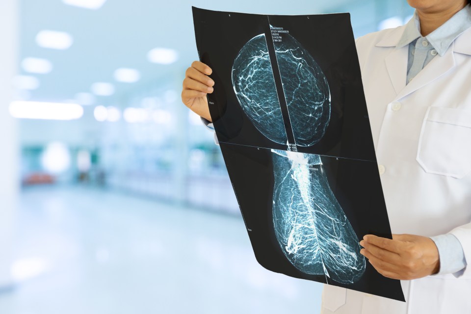 AI could cut waiting times for breast cancer screening by nearly halving medics’ workloads