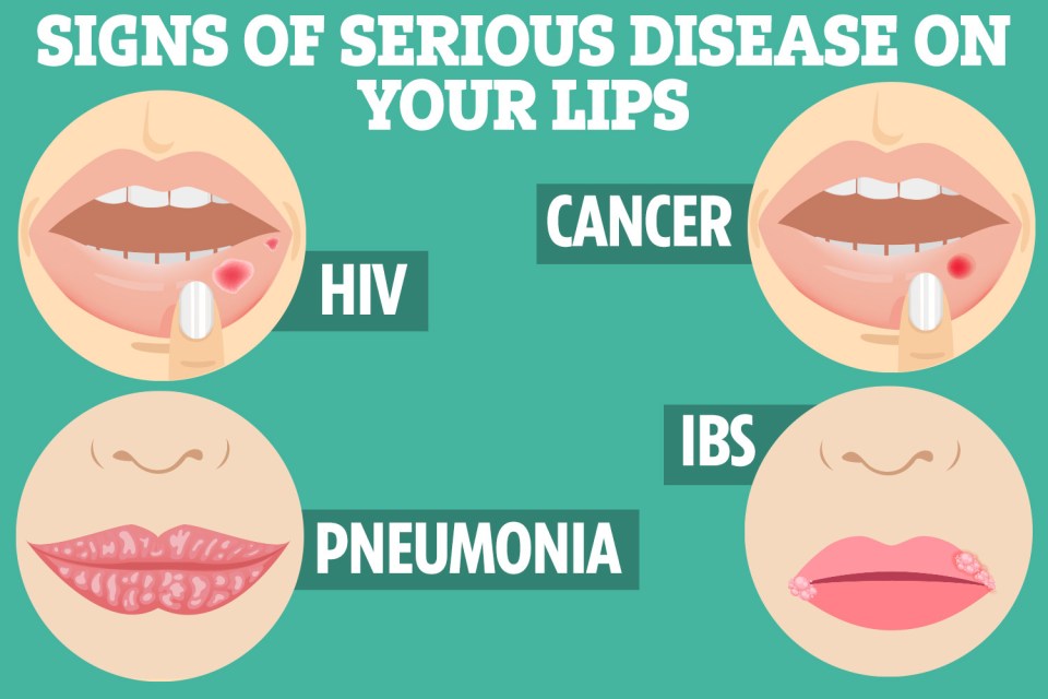 The signs of serious disease you can spot on your lips