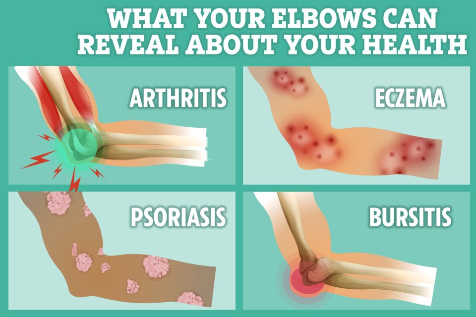 Your elbows can reveal a surprising amount about your health