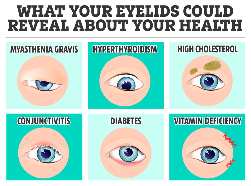 The six health conditions you can spot in your eyelids