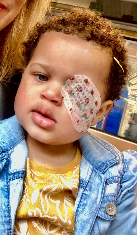 Little Amelia had her eye removed after being diagnosed with cancer