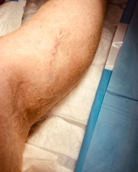 He took to Instagram to show how just a small scar remains in place of a growth that was removed