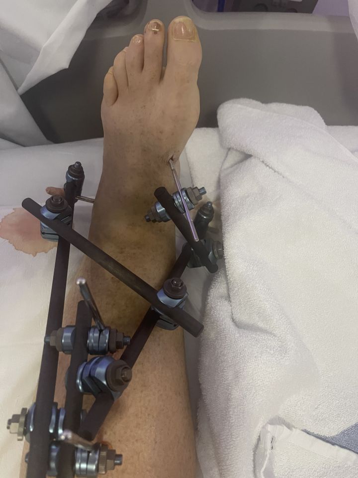 Doctors had to perform two operations on her foot