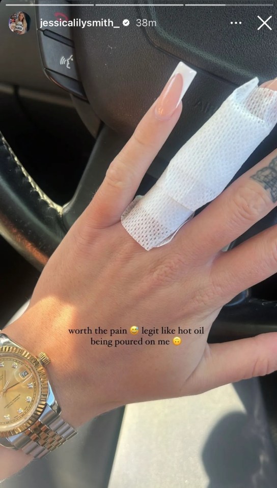 Jessica had the engagement ring tattoo removed