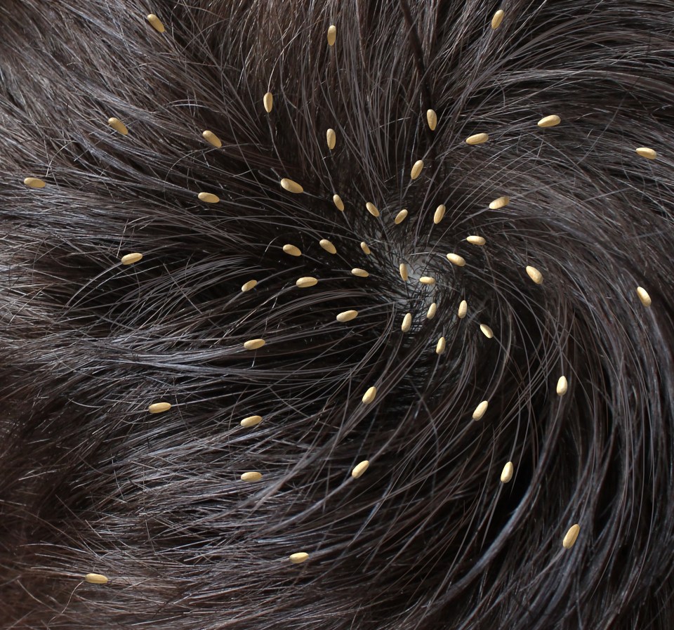 Nits are the eggs lice hatch from, which are oval shaped and cling to the roots of the hair