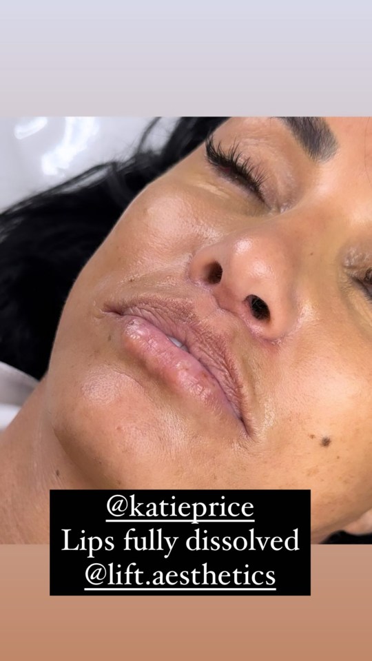 Katie Price showed off her natural lips before topping them up once again