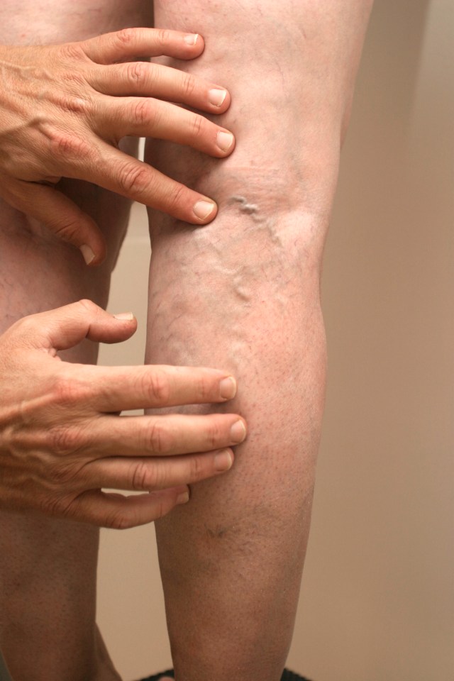 Varicose veins can be blue or purple and look lumpy, bulging or twisted