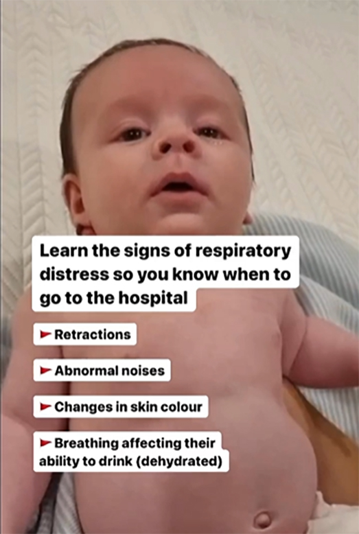 Tiny Hearts Education shared a video of what RSV-induced respiratory distress looks like in newborns