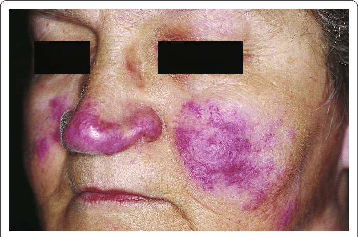 An autoimmune condition can leave the nose looking bruised