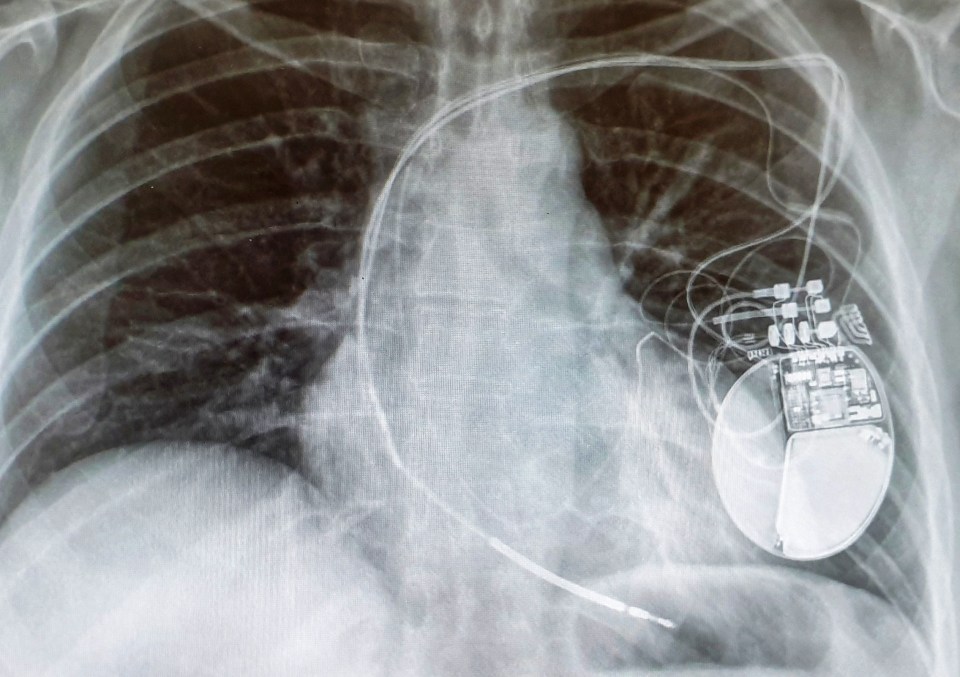 She has a pacemaker and ICD fitted in her chest (pictured)