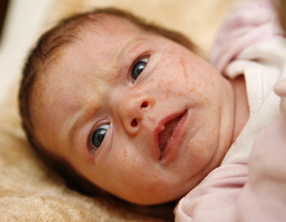 he majority of parents worry about a skin complaint in their baby's first year