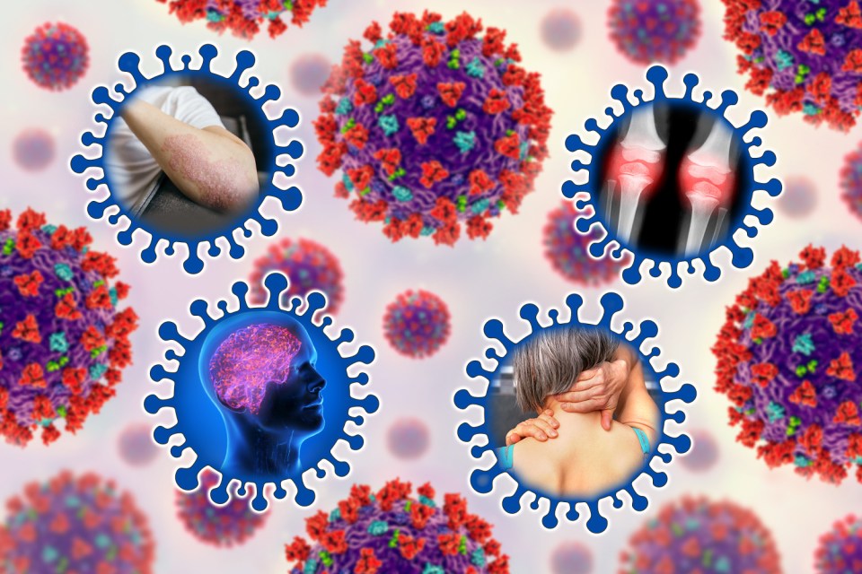 Covid-19 has been connected to a rise in a autoimmune diseases