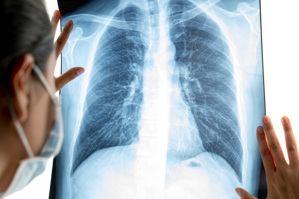 AI to help doctors spot lung cancer quicker and more accurately is set to be rolled out at NHS hospitals in England