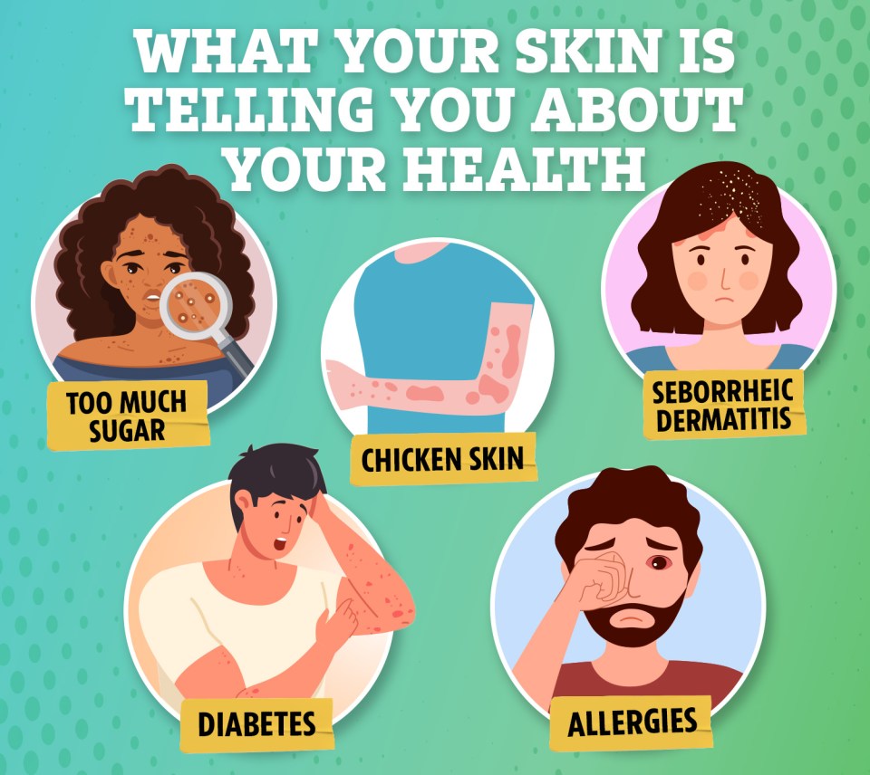 While breakouts might indicate you're eating too much sugar, conditions like diabetes could actually take an affect on your skin, making it dry and prone to infection