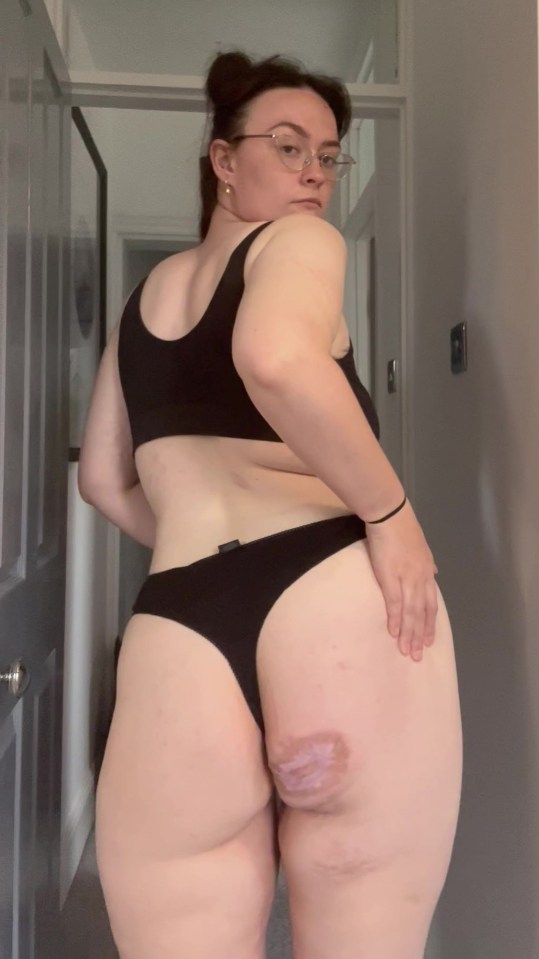 It caused the skin on her bum, boobs and armpits to 'eat itself', which has left scars