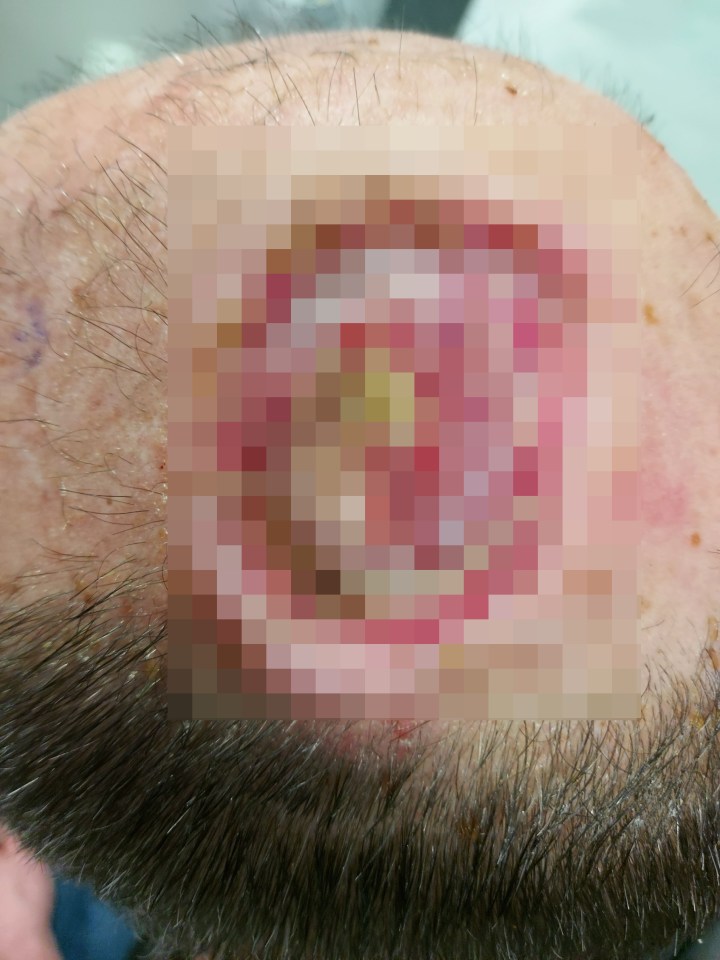 The dad underwent surgery to remove two moles on his head, which left him with gaping holes