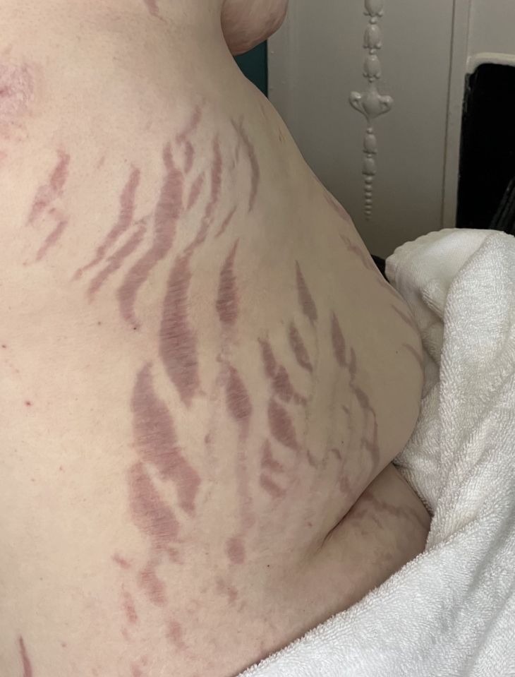 She is now left looking like 'a purple zebra' due to scars and stretch marks