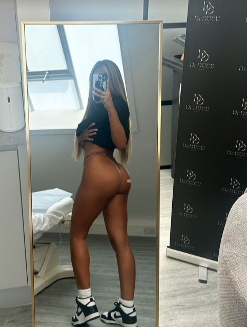 Natalia recently shoed off the results of her bum fillers